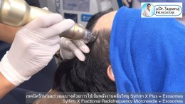 แนะนำเทคนิคดูแลผมร่วงผมบางด้วย Sylfirm X Fractional RF Microneedle + Exosomes for Hair Loss Treatment