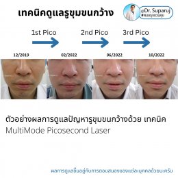แนะนำเทคนิคดูแลรูขุมขนกว้าง: ตัวอย่างผลการดูแลรูขุมขนกว้าง Enlarged Facial Pore ด้วย MultiMode Picosecond Laser