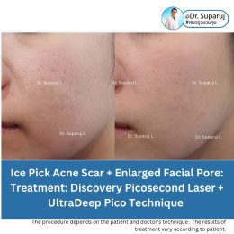 แนะนำเทคนิคดูแลหลุมสิวลึก Ice pick & Boxcar Acne Scar: เทคนิค UltraDeep Pico Technique