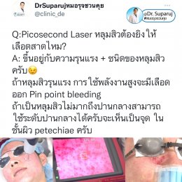 Q:Picosecond Laser หลุมสิวต้องยิงให้เลือดสาดไหม?