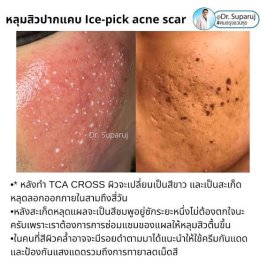 เป็นคนเจ็บง่าย (มากๆ) แต่อยากรักษาหลุมสิว มีเทคนิคอย่างไร? : เทคนิคลดอาการเจ็บจากการรักษาหลุมสิว