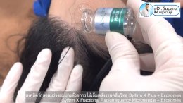 แนะนำเทคนิคดูแลผมร่วงผมบางด้วย Sylfirm X Fractional RF Microneedle + Exosomes for Hair Loss Treatment