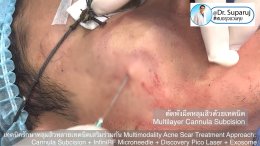 เทคนิครักษาหลุมสิวด้วยหลายเทคนิคเสริมร่วมกัน Multimodality Acne Scar Treatment Approach: Cannula Subcision + InfiniRF Microneedle + Discovery Pico Laser + Exosome