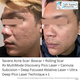 Update รักษาหลุมสิวด้วยเทคนิคการตัดพังผืด Blunt Blade Subcision (Blunt Blade Subcision for Acne Scar Fibrosis Treatment)