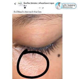 มีตุ่มเล็กๆสีขาวเหลืองหลายๆตุ่มที่เปลือกตาล่างคืออะไร : เป็นต่อมไขมันที่เด่นชัดครับ Prominent sebaceous gland ครับ
