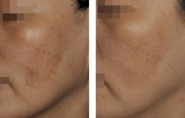 แนะนำเทคนิคดูแลฝ้า ด้วย SYLFIRM X Plus (SYLFIRMX Plus Fractional Radiofrequency Microneedle to Treat Melasma)