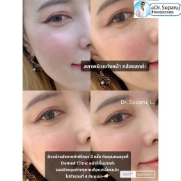 รีวิวรักษาหลุมสิวด้วย Pico Laser +Exosome มันเริดมากแม๊