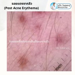 แนะนำเทคนิคดูแลรอยแดงสิว เส้นเลือดฝอย : เทคนิครักษารอยแดงสิว เส้นเลือดฝอย ด้วย Discovery Picosecond Laser PT Microsecond Pulses Mode 