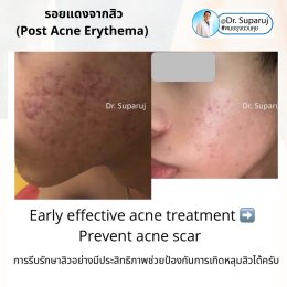 แนะนำเทคนิคดูแลรอยแดงสิว เส้นเลือดฝอย : เทคนิครักษารอยแดงสิว เส้นเลือดฝอย ด้วย Discovery Picosecond Laser PT Microsecond Pulses Mode 