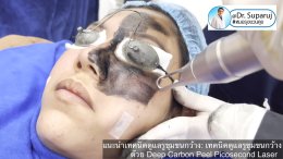 แนะนำเทคนิคดูแลรูขุมขนกว้าง: เทคนิคดูแลรูขุมขนกว้างด้วย Deep Carbon Peel Picosecond Laser (เทคนิคการใช้ Picosecond Laser พิโค่เลเซอร์ ร่วมกับผง carbon กระตุ้นการสร้างคอลลาเจนดูแลรูขุมขนกว้าง )