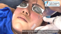 แนะนำเทคนิคดูแลรูขุมขนกว้าง: เทคนิคดูแลรูขุมขนกว้างด้วย Deep Carbon Peel Picosecond Laser (เทคนิคการใช้ Picosecond Laser พิโค่เลเซอร์ ร่วมกับผง carbon กระตุ้นการสร้างคอลลาเจนดูแลรูขุมขนกว้าง )