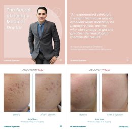 "แนะนำเทคนิคดูแลผิวหลังรักษาหลุมสิวด้วยเลเซอร์ครับIntroducing Techniques for Caring for and Treating Acne Scars with Laser"