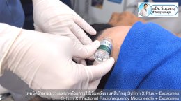 แนะนำ เทคนิครักษาผมร่วงผมบางด้วยการใช้เข็มพลังงานคลื่นวิทยุ Sylfirm X Plus + Exosomes (Sylfirm X Fractional Radiofrequency Microneedle + Exosomes)