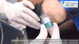 แนะนำเทคนิคดูแลผมร่วงผมบางด้วย Sylfirm X Fractional RF Microneedle + Exosomes for Hair Loss Treatment