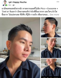 "แนะนำเทคนิคดูแลผิวหลังรักษาหลุมสิวด้วยเลเซอร์ครับIntroducing Techniques for Caring for and Treating Acne Scars with Laser"