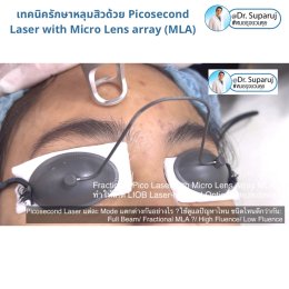 แนะนำเทคนิคดูแลหลุมสิว: Picosecond Laser แต่ละ Mode แตกต่างกันอย่างไร ?  ใช้ดูแลปัญหาไหน ชนิดไหนดีกว่ากัน: Full Beam/ Fractional MLA ?/ High Fluence/ Low Fluence