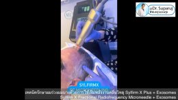 แนะนำเทคนิคดูแลผมร่วงผมบางด้วย Sylfirm X Fractional RF Microneedle + Exosomes for Hair Loss Treatment