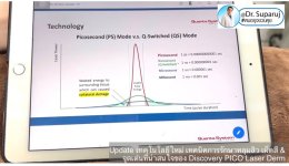 Update เทคโนโลยีใหม่ เทคนิคการรักษาหลุมสิว เม็ดสี & จุดเด่นที่น่าสนใจของ Discovery PICO Laser Derm