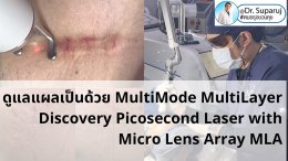 เทคนิคดูแลแผลเป็นด้วยเทคนิค MultiMode MultiLayer Discovery Picosecond Laser with Micro Lens Array MLA