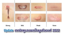 Update เทคนิคดูแลแผลเป็นนูนคีลอยด์ 2022