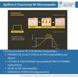 "แนะนำเทคนิคดูแลผิวหลังรักษาหลุมสิวด้วยเลเซอร์ครับIntroducing Techniques for Caring for and Treating Acne Scars with Laser"