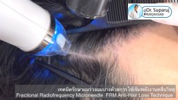 แนะนำเทคนิครักษาผมร่วงผมบาง: เทคนิครักษาผมร่วงผมบางด้วยการใช้เข็มพลังงานคลื่นวิทยุ Fractional Radiofrequency Microneedle FRM Anti-Hair Loss Technique