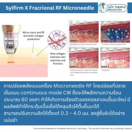 "แนะนำเทคนิคดูแลผิวหลังรักษาหลุมสิวด้วยเลเซอร์ครับIntroducing Techniques for Caring for and Treating Acne Scars with Laser"