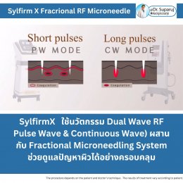 Update เทคนิคยกกระชับผิว หลุมสิว ดูแลปัญหาเม็ดสี ฝ้า+เส้นเลือด ด้วยนวัตกรรมคลื่นวิทยุแบบเข็ม Fractional microneedle Radiofrequency : SYLFIRM X