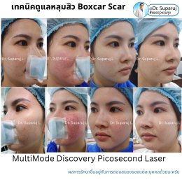 แนะนำเทคนิครักษาหลุมสิว: หัวยิงพิเศษรักษาหลุมสิว Fractional MLA 8 mm. ของ Discovery Pico Laser