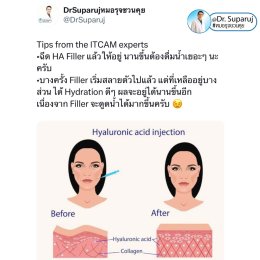 Update เทคนิคกระตุ้นการสร้างคอลลาเจนในผิวหนังลดเลือนริ้วรอย: Collagen Biostimulator