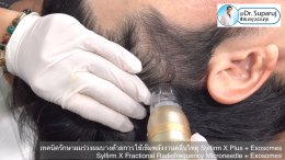 แนะนำเทคนิคดูแลผมร่วงผมบางด้วย Sylfirm X Fractional RF Microneedle + Exosomes for Hair Loss Treatment