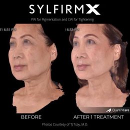 แนะนำเทคนิคดูแลฝ้า ด้วย SYLFIRM X Plus (SYLFIRMX Plus Fractional Radiofrequency Microneedle to Treat Melasma)