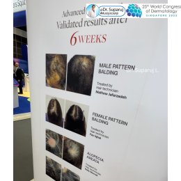 Update จากการประชุมแพทย์ผิวหนังระดับโลก WCD 2023: นวัตกรรมในการดูแลผมร่วงผมบางด้วยการใช้ Calecim Advanced Hair System
