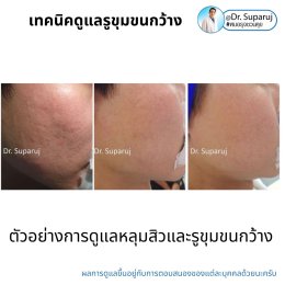 แนะนำเทคนิคดูแลรูขุมขนกว้าง: ตัวอย่างผลการดูแลรูขุมขนกว้าง Enlarged Facial Pore ด้วย MultiMode Picosecond Laser