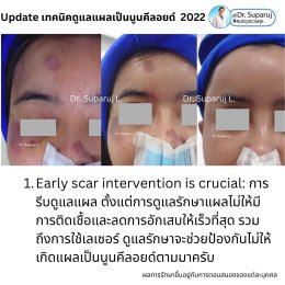 Update เทคนิคดูแลแผลเป็นนูนคีลอยด์ 2022