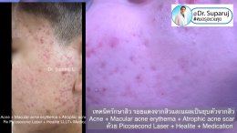 แนะนำเทคนิคดูแลรักษาสิวและหลุมสิว: ดูแลรอยแดงจากสิวและแผลเป็นยุบตัวจากสิว Acne + Macular acne erythema + Atrophic acne scar ดูแลด้วย Picosecond Laser + Healite + Medication