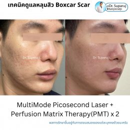 เทคนิคการดูแลหลุมสิว: ตัวอย่างการดูแลหลุมสิวแบบขอบชัดและแบบยุบตัวด้วยการใช้ Picosecond Laser + Perfusion Matrix Therapy