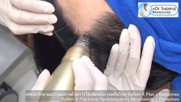 แนะนำ เทคนิครักษาผมร่วงผมบางด้วยการใช้เข็มพลังงานคลื่นวิทยุ Sylfirm X Plus + Exosomes (Sylfirm X Fractional Radiofrequency Microneedle + Exosomes)