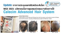 Update จากการประชุมแพทย์ผิวหนังระดับโลก WCD 2023: นวัตกรรมในการดูแลผมร่วงผมบางด้วยการใช้ Calecim Advanced Hair System