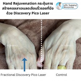 เทคนิคดูแลริ้วรอย เหี่ยวย่น กระตุ้นการสร้างคอลลาเจน ที่ส่วนลำคอหน้าอก แขน มือ หน้าอก ด้วย Discovery Pico Laser