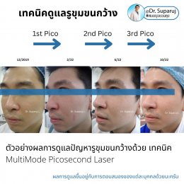 แนะนำเทคนิคดูแลรูขุมขนกว้าง: ตัวอย่างผลการดูแลรูขุมขนกว้าง Enlarged Facial Pore ด้วย MultiMode Picosecond Laser