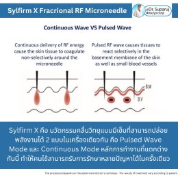 "แนะนำเทคนิคดูแลผิวหลังรักษาหลุมสิวด้วยเลเซอร์ครับIntroducing Techniques for Caring for and Treating Acne Scars with Laser"
