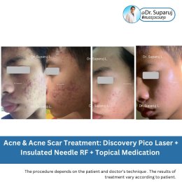 Update รักษาหลุมสิวด้วยเทคนิคการตัดพังผืด Blunt Blade Subcision (Blunt Blade Subcision for Acne Scar Fibrosis Treatment)