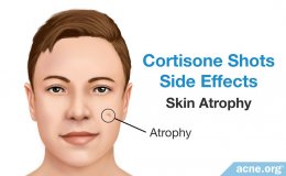 ฉีดสิวแล้วเป็นรอยบุ๋มยุบตัว เกิดจากอะไรดูแลได้อย่างไรบ้าง ?  (Skin atrophy after intralesional steroid injection for nodulocystic acne treatment )