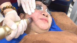 "แนะนำเทคนิคดูแลผิวหลังรักษาหลุมสิวด้วยเลเซอร์ครับIntroducing Techniques for Caring for and Treating Acne Scars with Laser"