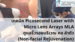 แนะนำ เทคนิคการใช้เลเซอร์ Picosecond Laser with Micro Lens Arrays MLA เพื่อดูแลริ้วรอยบริเวณ คอ ลำตัว (Non-facial rejuvenation)