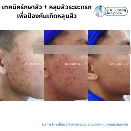 แนะนำเทคนิคดูแลรักษาสิวและหลุมสิว: ดูแลรอยแดงจากสิวและแผลเป็นยุบตัวจากสิว Acne + Macular acne erythema + Atrophic acne scar ดูแลด้วย Picosecond Laser + Healite + Medication