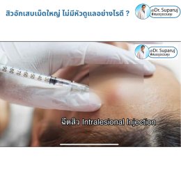 มีสิวอักเสบเม็ดใหญ่ ไม่มีหัว ขึ้น ดูแลอย่างไรดี ?