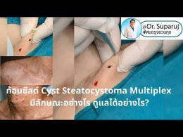 แนะนำเทคนิคดูแล ก้อนซีสต์จากท่อต่อมไขมัน Steatocystoma Multiplex (SM) ด้วย เข็มพลังงานคลื่นวิทยุ Insulated Radiofrequency RF Microneedle for Steatocystoma Multiplex Treatment