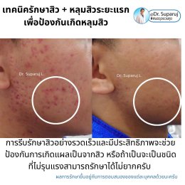 แนะนำเทคนิคดูแลรักษาสิวและหลุมสิว: ดูแลรอยแดงจากสิวและแผลเป็นยุบตัวจากสิว Acne + Macular acne erythema + Atrophic acne scar ดูแลด้วย Picosecond Laser + Healite + Medication